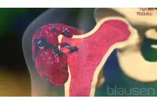 Kemik Kanseri Belirtileri ve Tedavisi