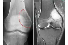 Kemik Tümörü Belirtileri ve Tedavisi