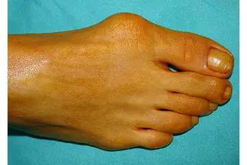 Ayak Kemiği Çıkıntısı Belirtileri ve Tedavisi